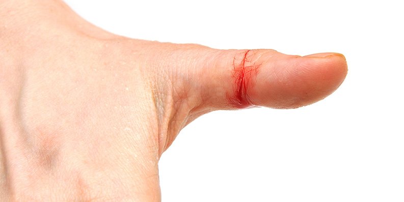„Aua, geschnitten…“ – Wie Verletzungen der Haut versorgen? ... schon gewusst?