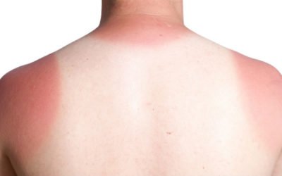 UV-Index zeigt Sonnenbrandrisiko ... schon gewusst?