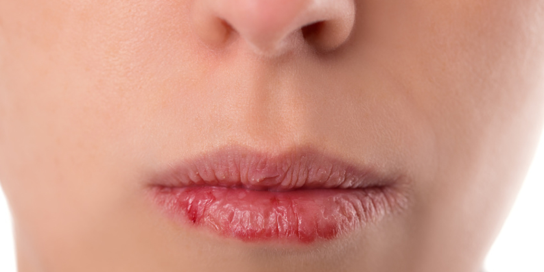Lippen – rissige und trockene Haut vermeiden